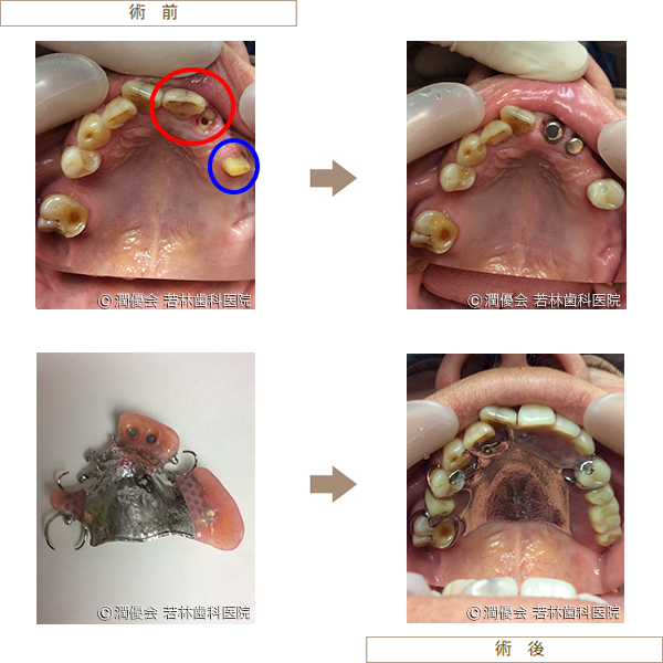 義歯の症例写真