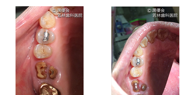 歯根分割施術中の画像2