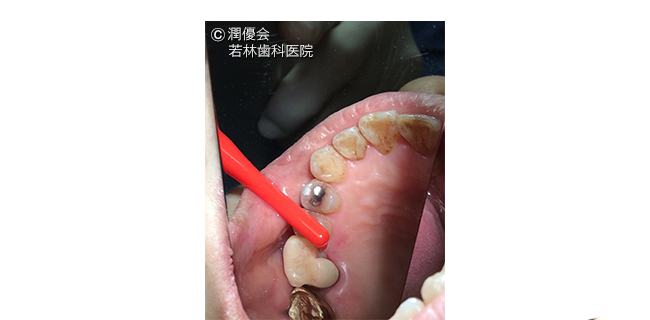 歯根分割施術中の画像3