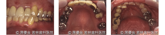 総合治療施術前のレントゲン及び口腔内写真2
