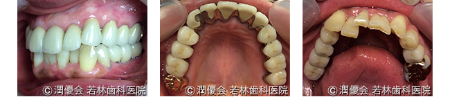 総合治療施術後のレントゲン及び口腔内写真2